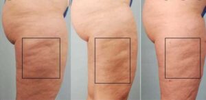 Best cellulite treatments that actually work