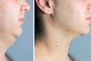Why Do You Have a Double Chin?