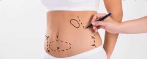 7 Health Benefits of Liposuction