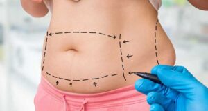 Are You Interested in Liposuction
