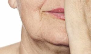 Jowls & Wrinkles Explained