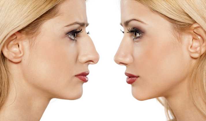 Nose Imperfections A Rhinoplasty Can Correct