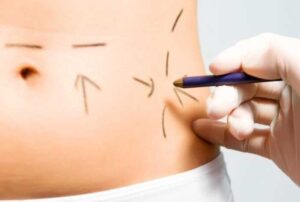 The Most Common Mistakes Made About Liposuction and Tummy Tuck Surgery