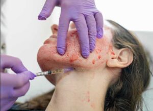 How Does a Vampire Facelift Differ from a PRP Facial