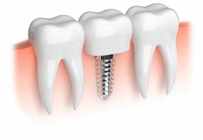 Dental Implant Benefits and Cost