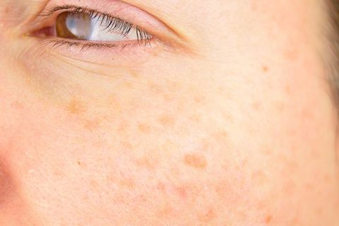 What are Age Spots and How to Remove Them?