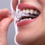 6 Common Signs You May Need a Night Guard for Teeth Grinding