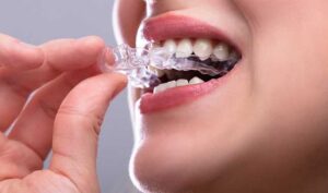 6 Common Signs You May Need a Night Guard for Teeth Grinding