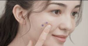 Will Overnight Spot Patches Work On Closed Lesions?