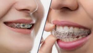 Best Invisalign Dentist in London