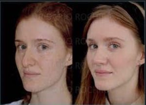 What to expect after rhinoplasty surgery in London?