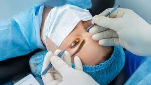 How Long Does LASIK Eye Surgery Last?