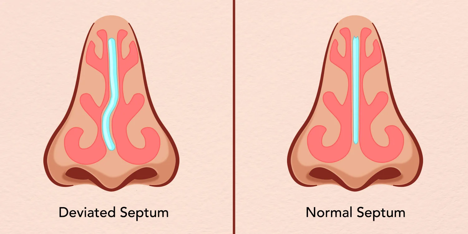 Identifying A Deviated Septum Telltale Signs To Pay Attention To Bulk Quotes Now